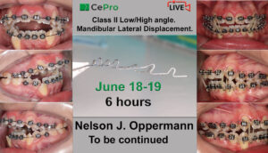 Recording of Nelson J. Oppermann webinars “Key aspects of class II diagnosis and treatment. Low and high angles. Deviations. Lateral displacement of the mandible. ”